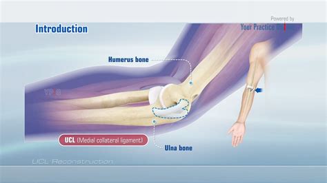 test for ucl tear|strained ucl recovery time.